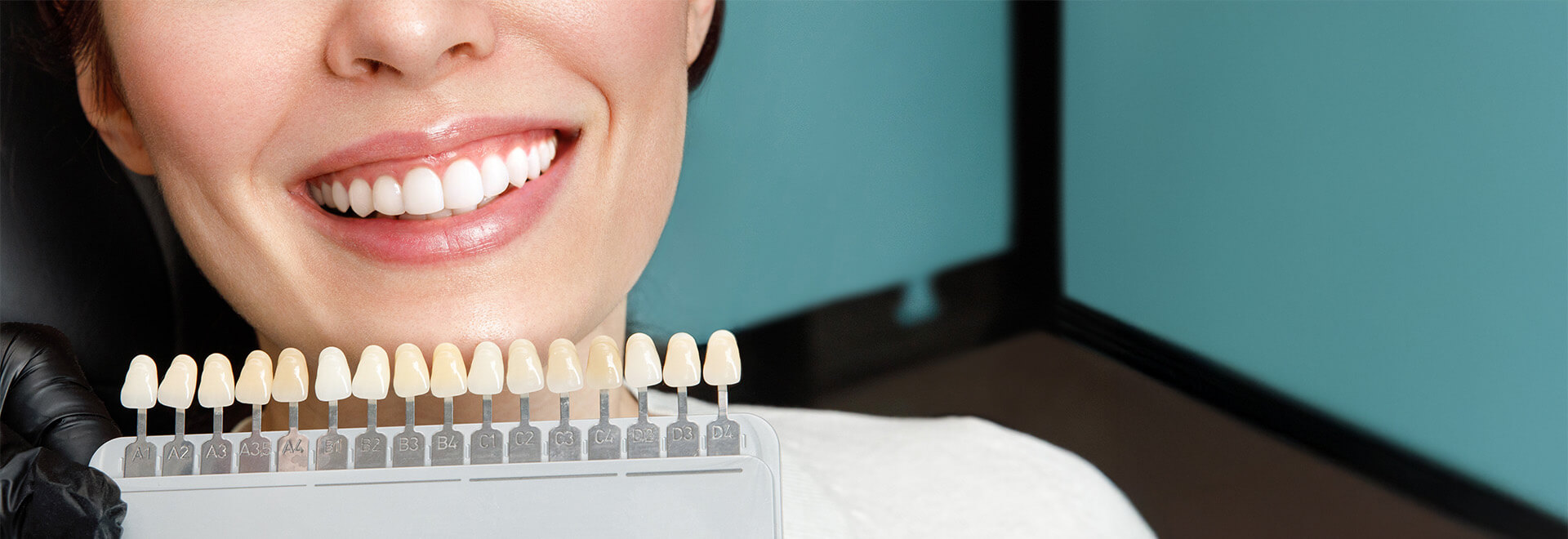 comparing tooth colors