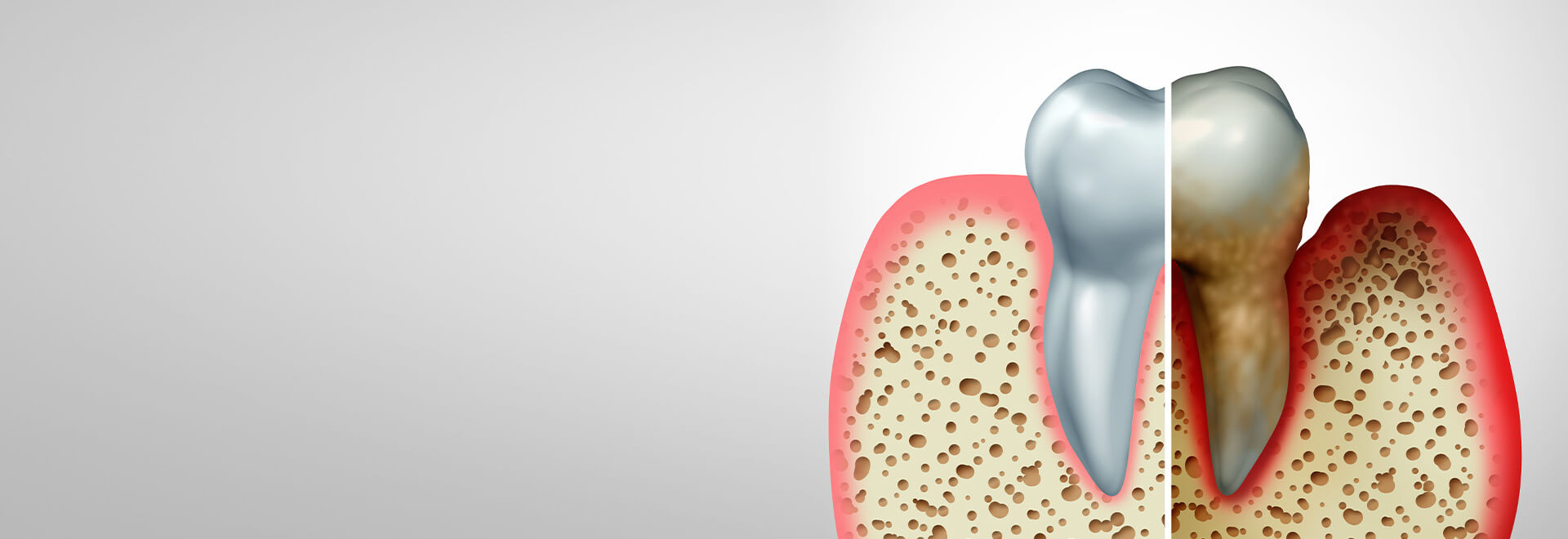 illustration of periodontal disease