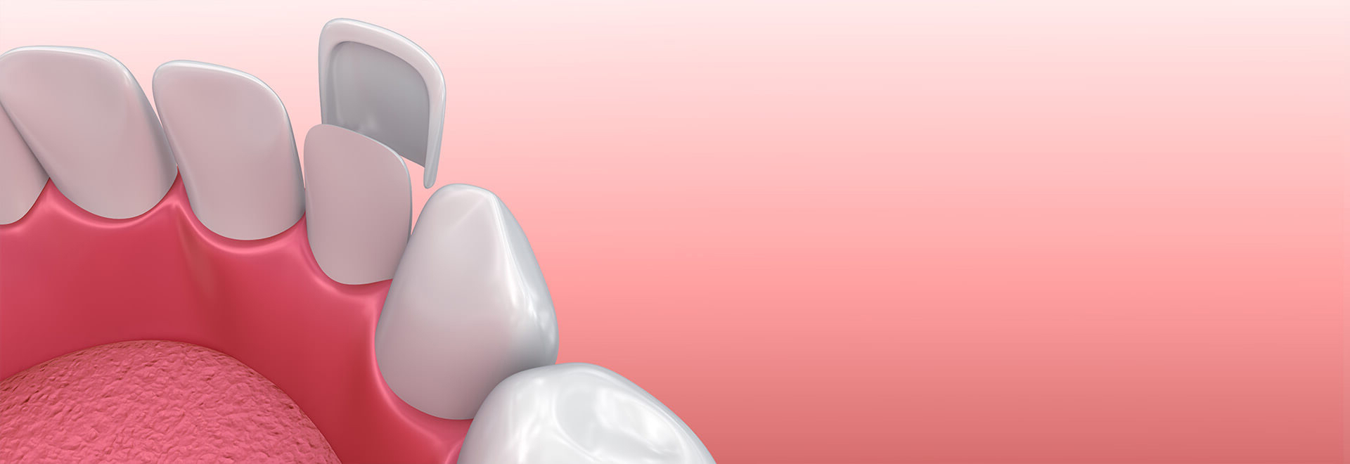 illustration of veneers